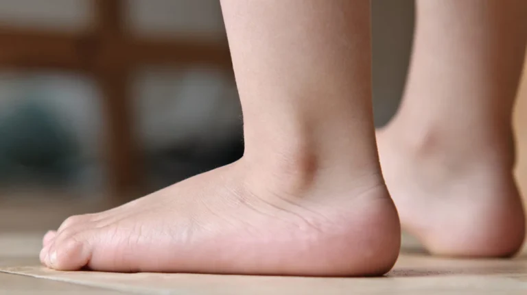 Do Flat Feet Cause Back Pain?