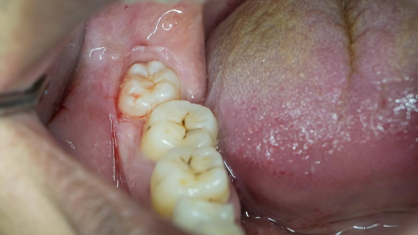 How long does wisdom tooth grow pain last?