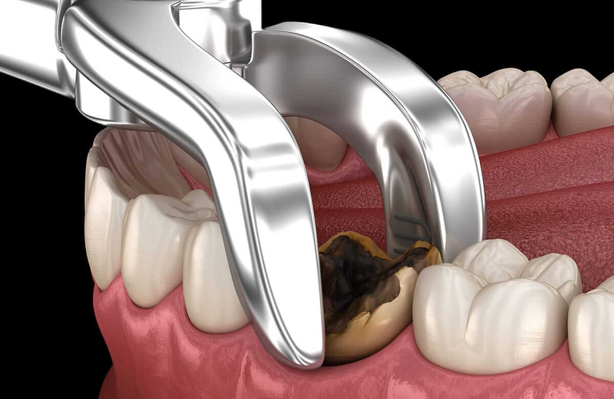 Understanding the Duration of Pain after Tooth Extraction