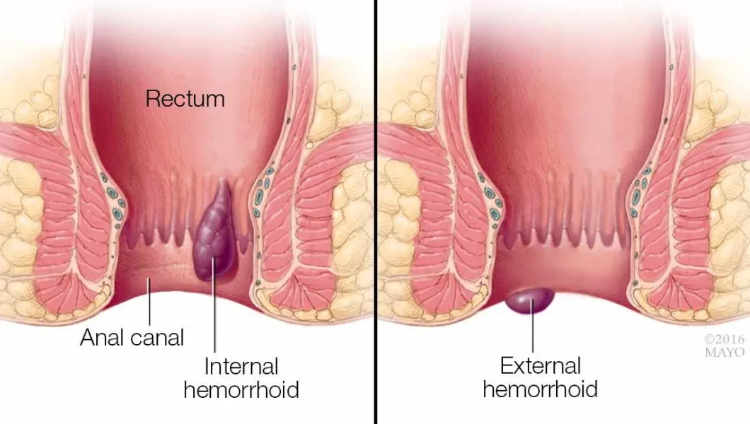 Hemorrhoid Pain Relief