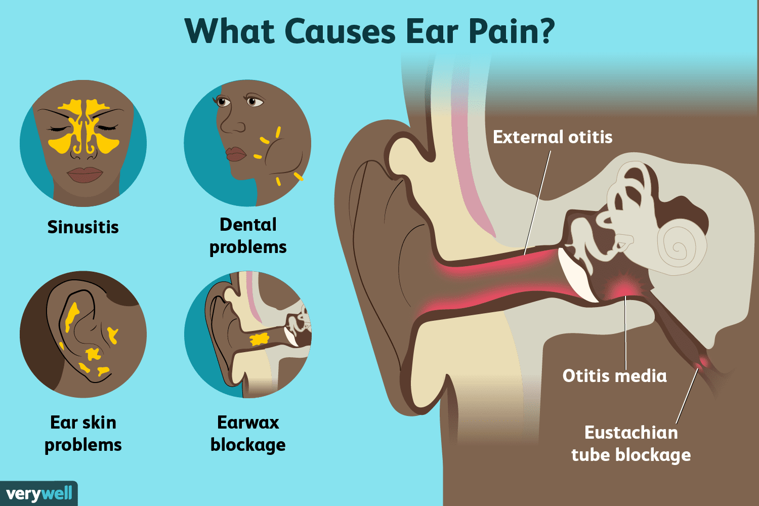 What Is Ear Pain Symptoms, Causes, Diagnosis