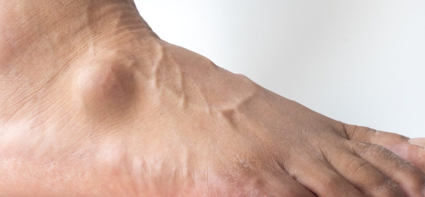 Lumps and Bumps on Top of Foot