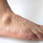 Lumps and Bumps on Top of Foot