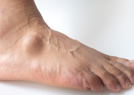 Lumps and Bumps on Top of Foot