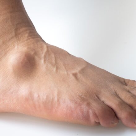 Lumps and Bumps on Top of Foot