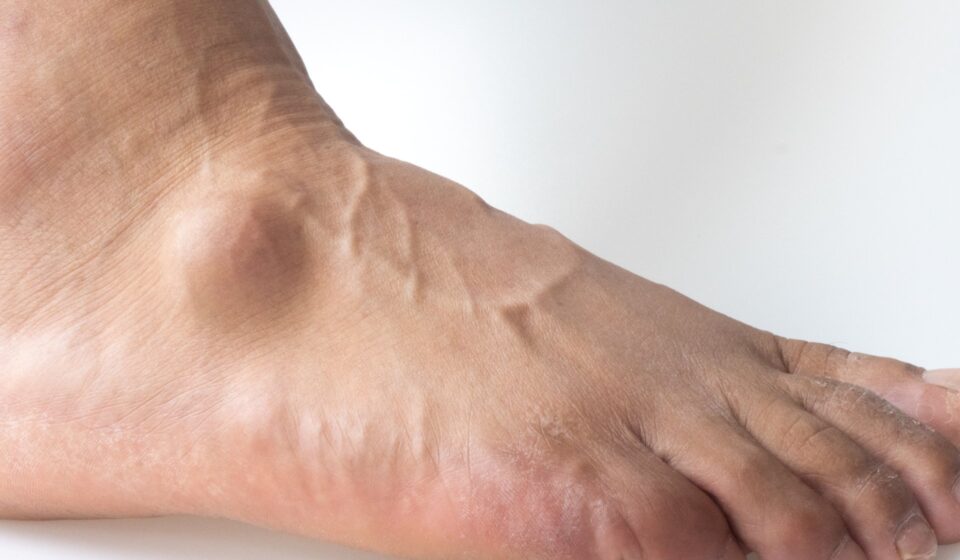 Lumps and Bumps on Top of Foot