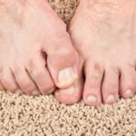 White Spots on Toenails