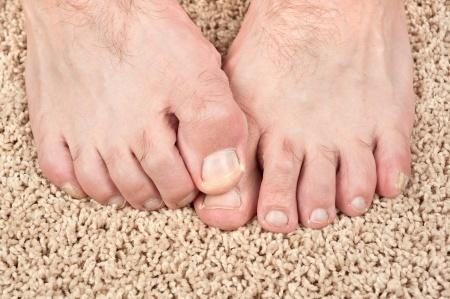 White Spots on Toenails