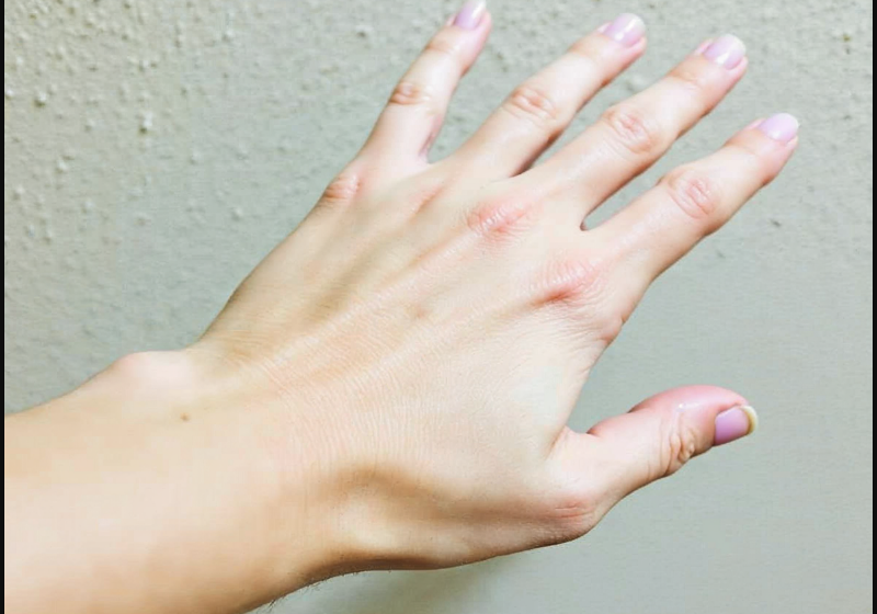 Natural Bug Bite Relief Remedies that Do Work Wonders