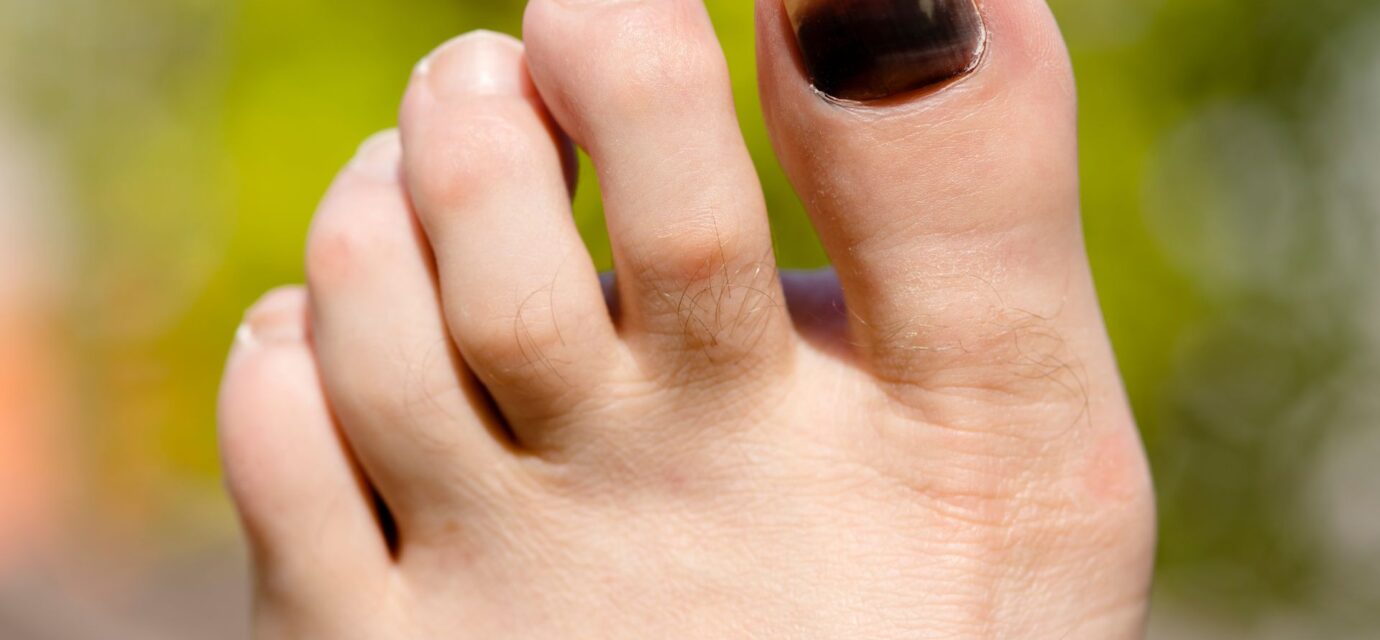 Black Toenail Fungus