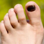 Black Toenail Fungus