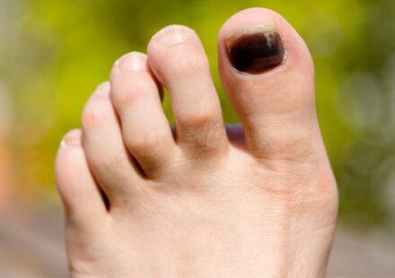 Black Toenail Fungus
