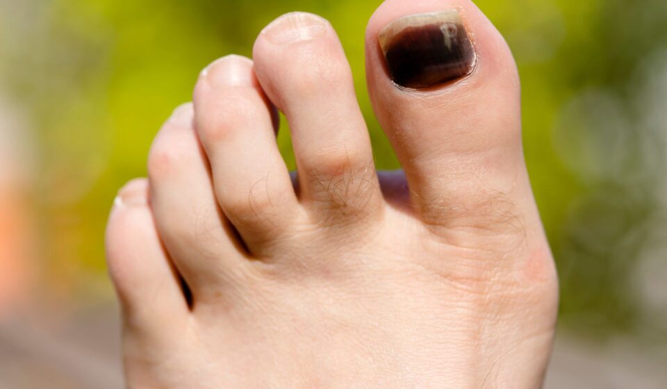 Black Toenail Fungus