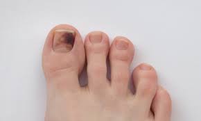 Black Spot on Toenail