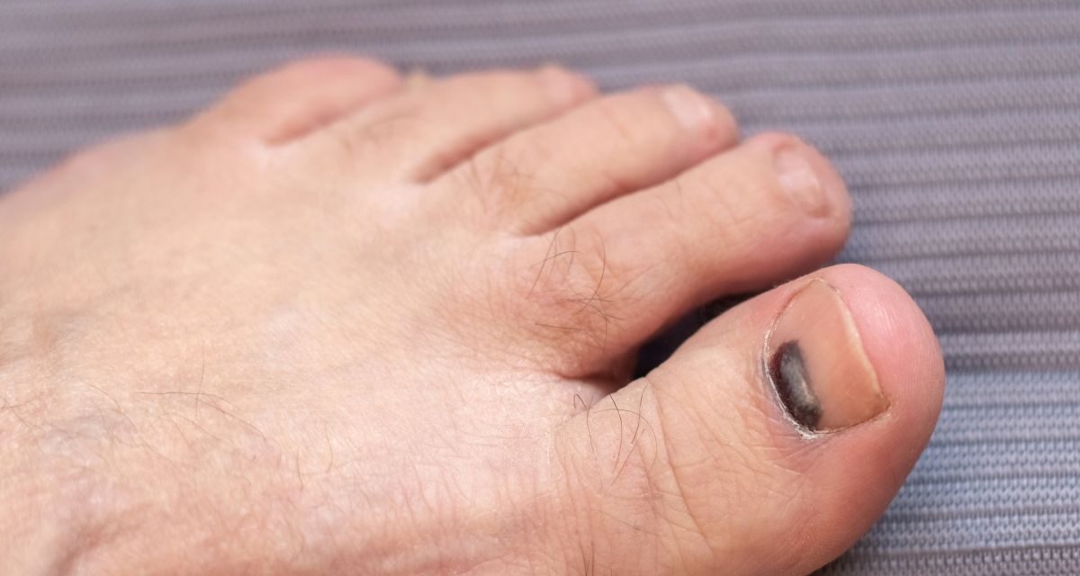 Bruised Toenail