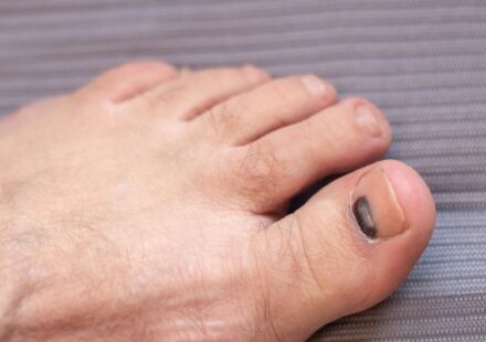 Bruised Toenail