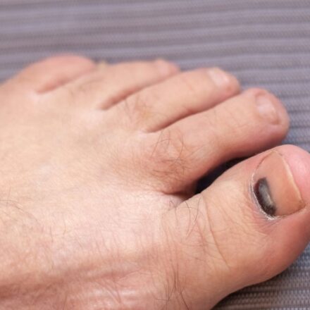 Bruised Toenail