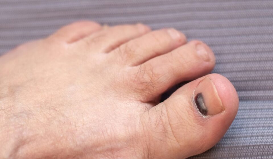 Bruised Toenail