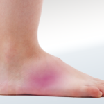 Pain on Outside of Foot